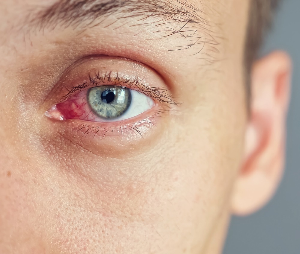 Close up of the red eye of a man affected by an infection